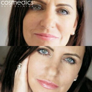 Before and after dermal filler