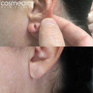 Split earlobe repair results