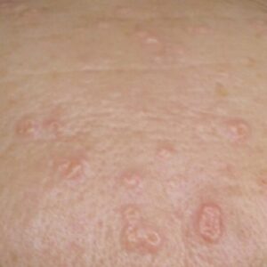 Sebaceous Hyperplasia