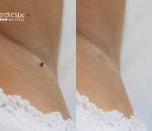 Skin Tag Removal Cosmedics