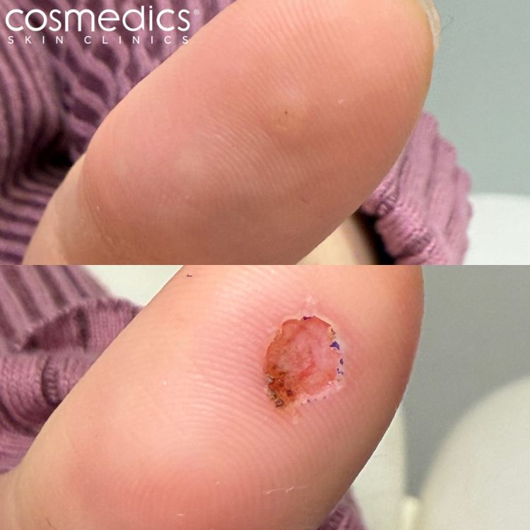 Wart Removal From Thumb Before After Results