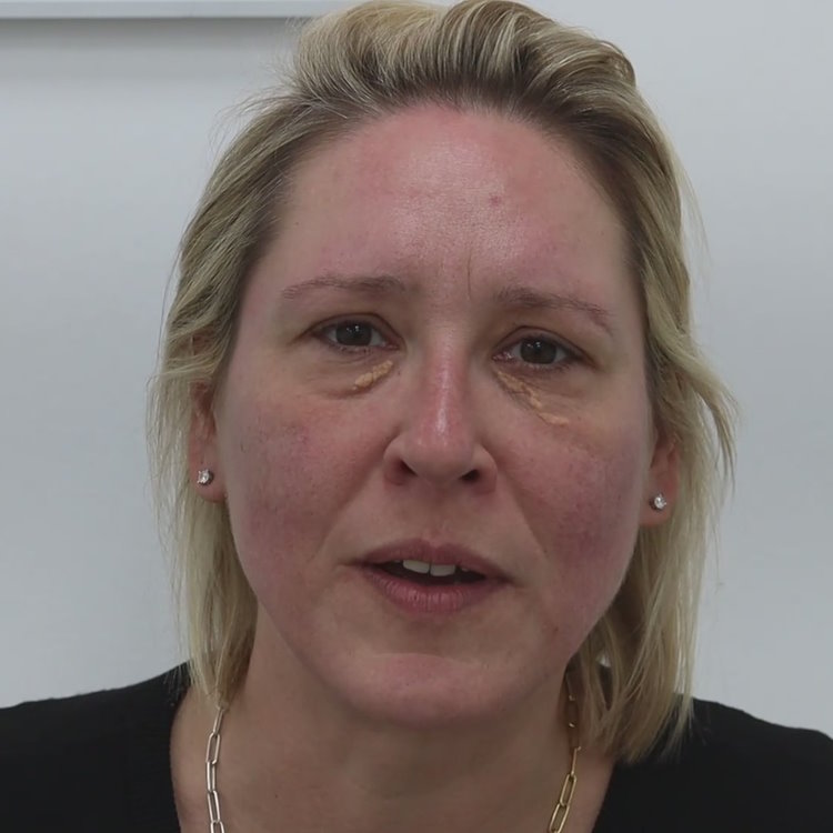 Xanthelasma video