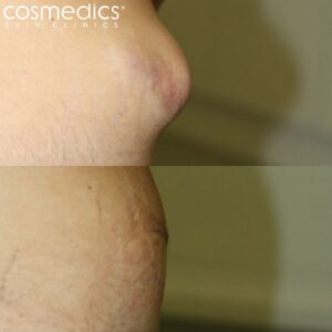 Large abdomen cyst removal before and after