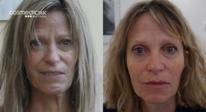 Bells Palsy Before And After BOTOX + Fillers