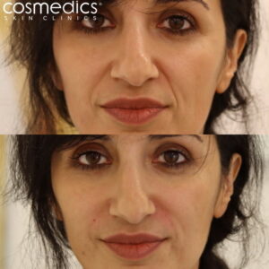 dermal fillers nose mouth lines