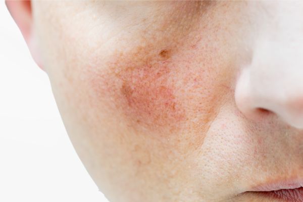 Laser Redness Treatment