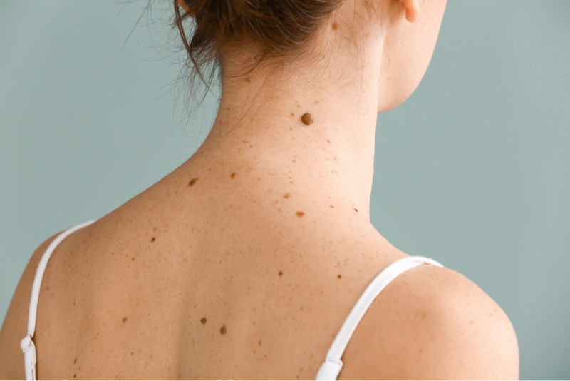 skin-tag