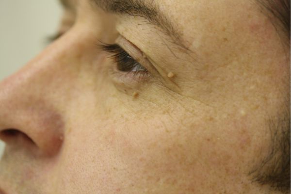 Skin Tags Face