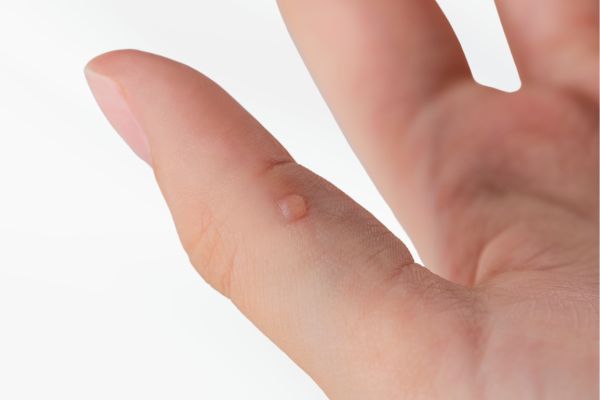 Wart Treatment