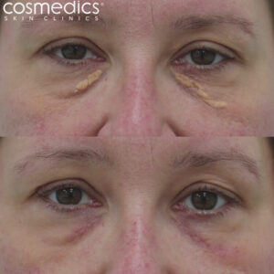 Xanthelasma before and after photo