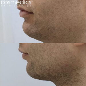 BELKYRA-male-double-chin-treatment-results-300x300.jpg
