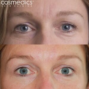 Before and after anti-wrinkle injections