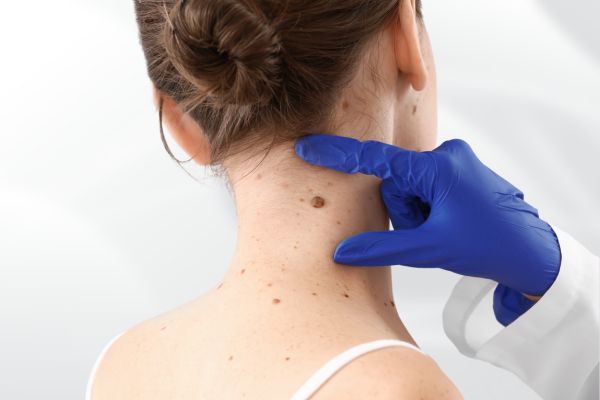 Ellipse Excision Mole Removal