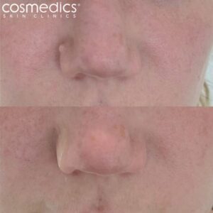 Mole removal laser and shave excision - nose