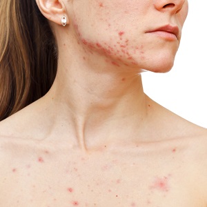 acne