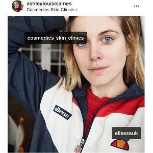 ashley james skin treatment