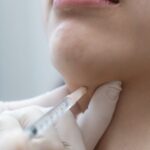 belkyra double chin treatment