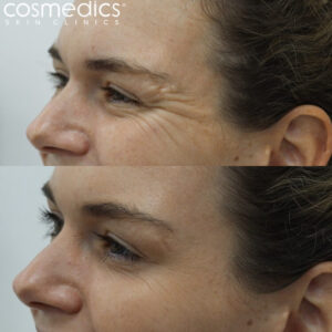 Botox crows feet results