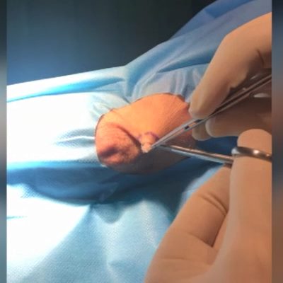 cyst removal demo