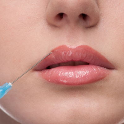 lip filler injections
