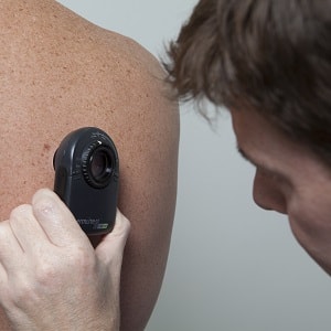 melanoma-check