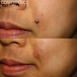 Before after mole on the cheek removed by shave excision and laser
