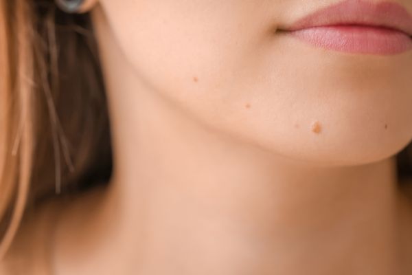 Mole Shave Excision Treatment