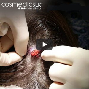 pilar-cyst-removal
