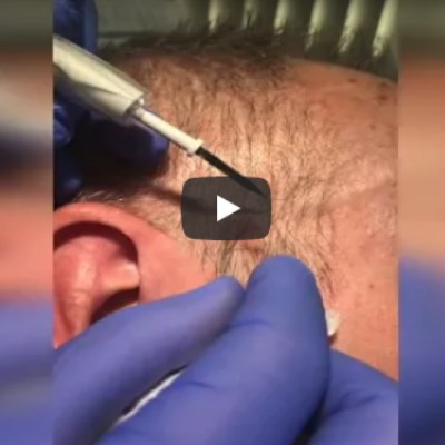 seborrhoeic keratosis removal