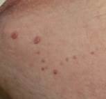 skin tag removal groin