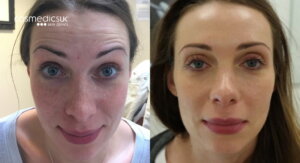 BOTOX® forehead treatment Results