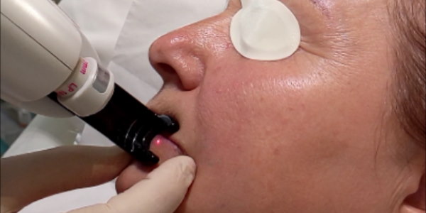Laser venous lake treatment