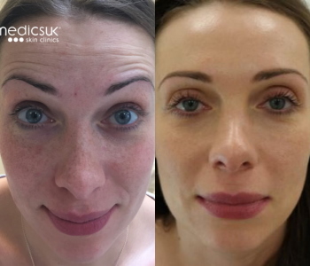 Botox Cosmedics