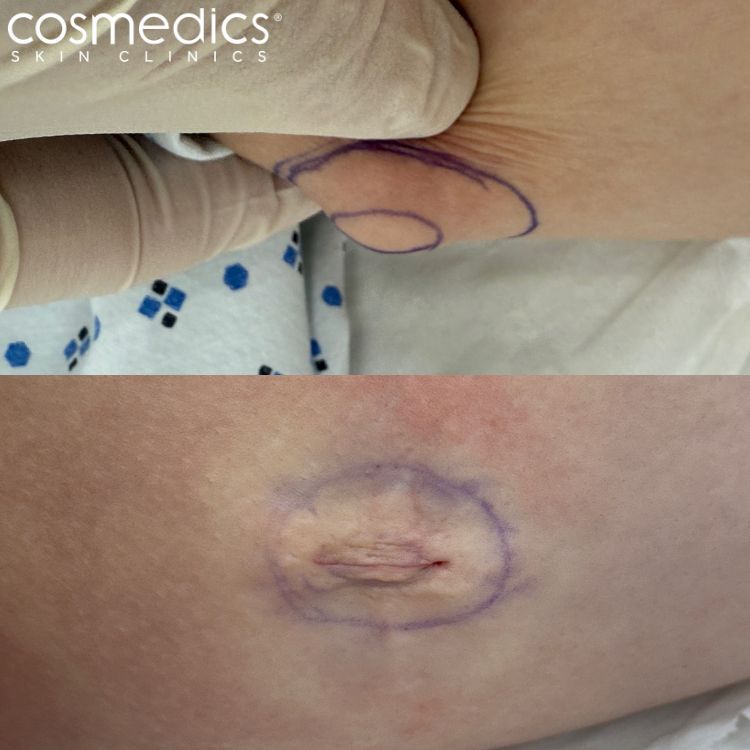 Lipoma Inner Thigh Before After Results
