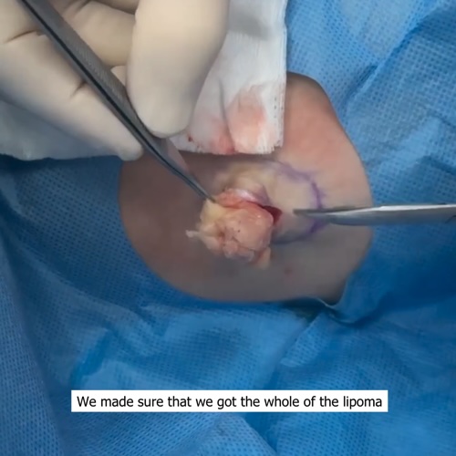 Lipoma removal from inner thigh - Dr Ross Perry Video