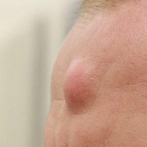 lipoma removal treatment