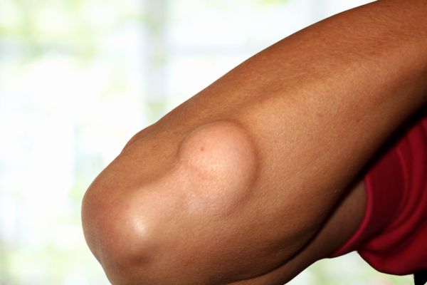 Lipoma Removal