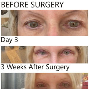 Upper blepharoplasty recovery