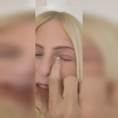 Upper blepharoplasty testimonial