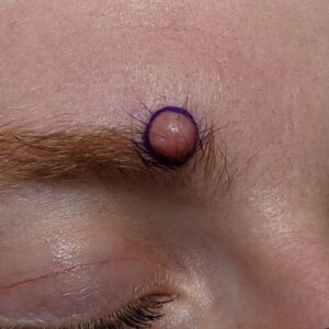 Eyebrow Cyst