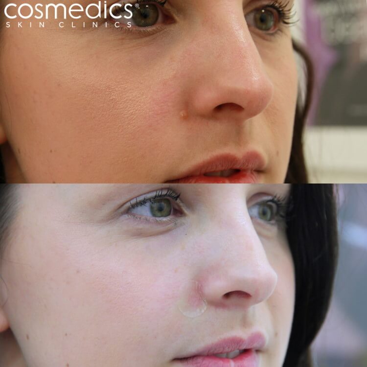 Mole removal on nose by radiosurgery