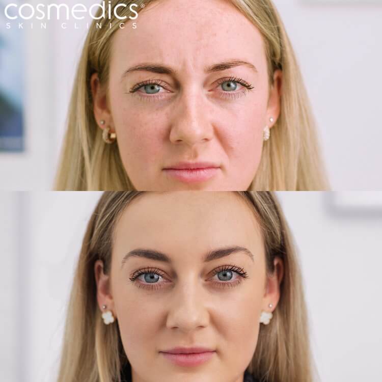 BOTOX Frown Before & After Lisa