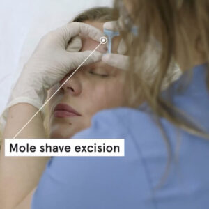Esther facial mole removal excision video