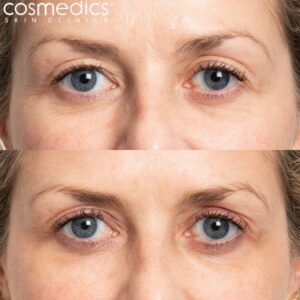 upper blepharoplasty before and after photos