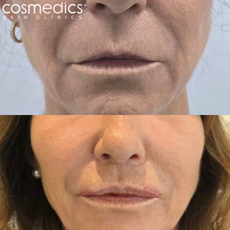 Lip Lift Before After Results Mr Sam Ghorbanian