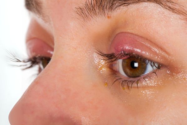 chalazion eye cyst removal