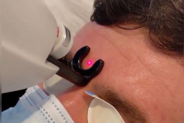 Cherry Angioma Treatment