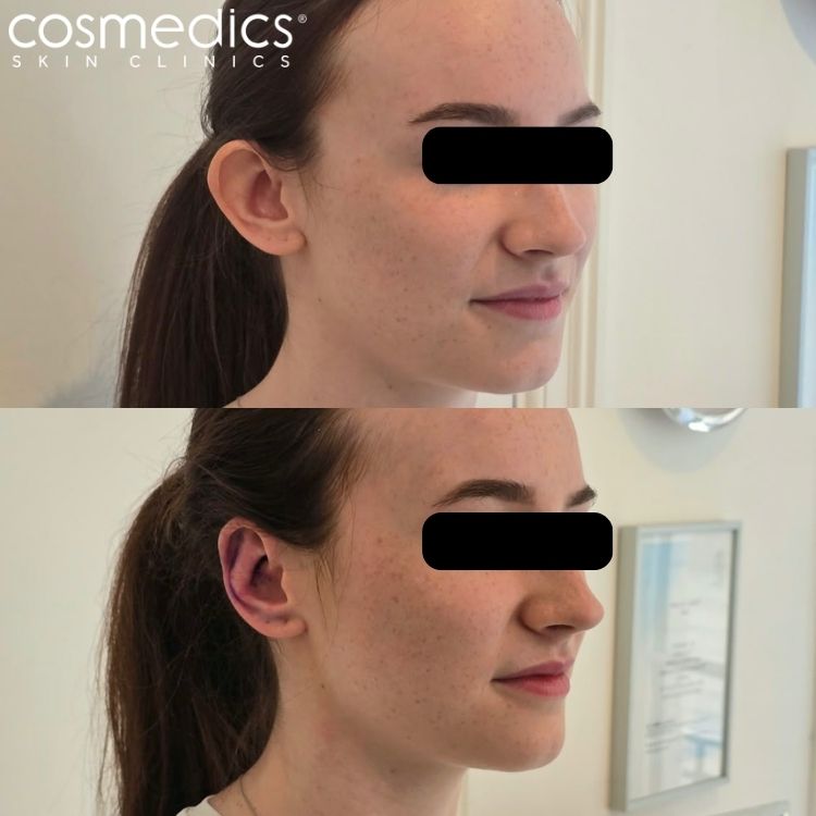 Otoplasty Before After Results Mr Sam Ghorbanian Profile