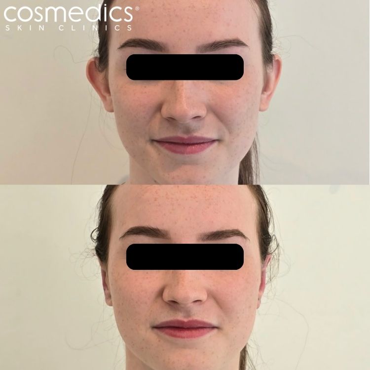 Otoplasty Before After Results Mr Sam Ghorbanian