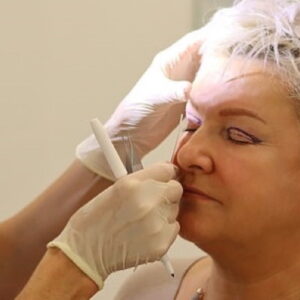 blepharoplasty eye lift london